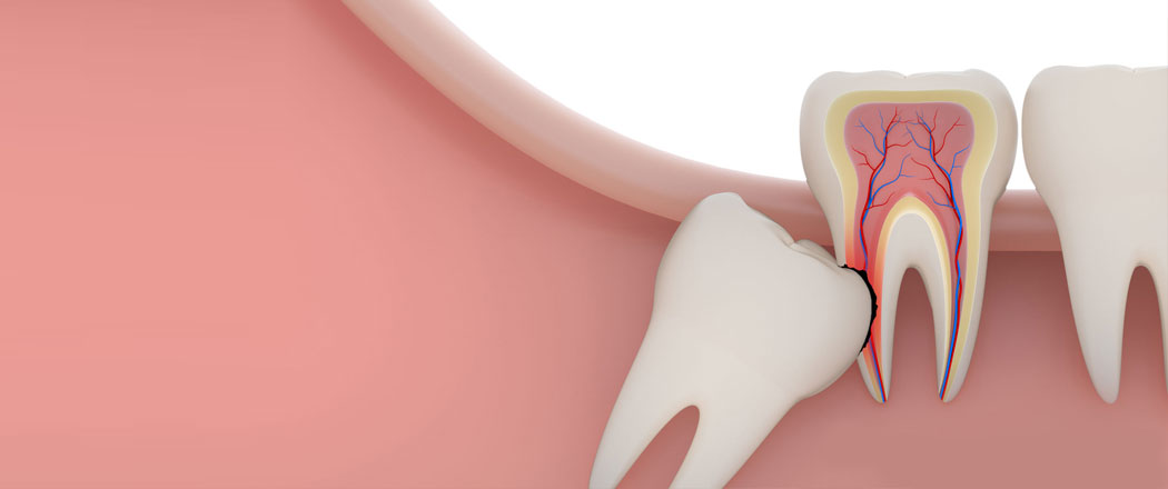 Wisdom Tooth Extraction Karve Nagar