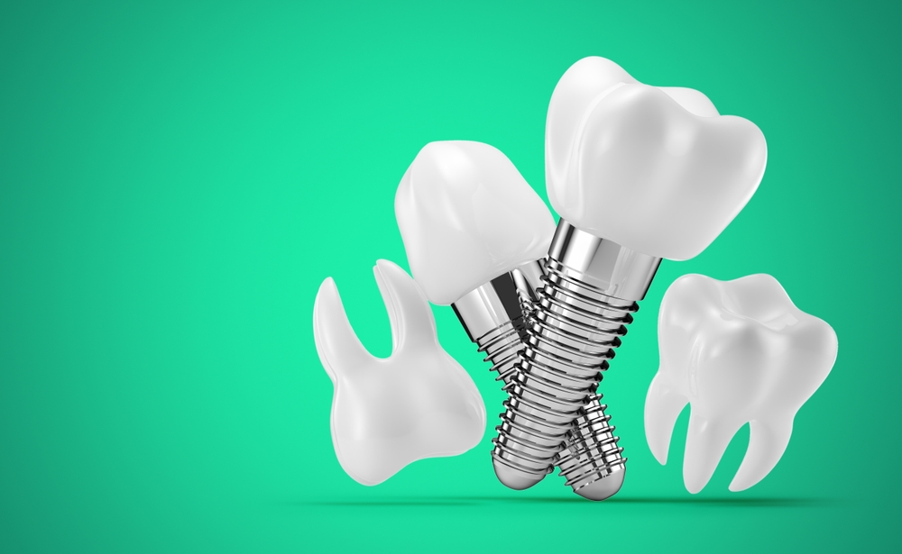Dental Implants Treatment Karve Nagar