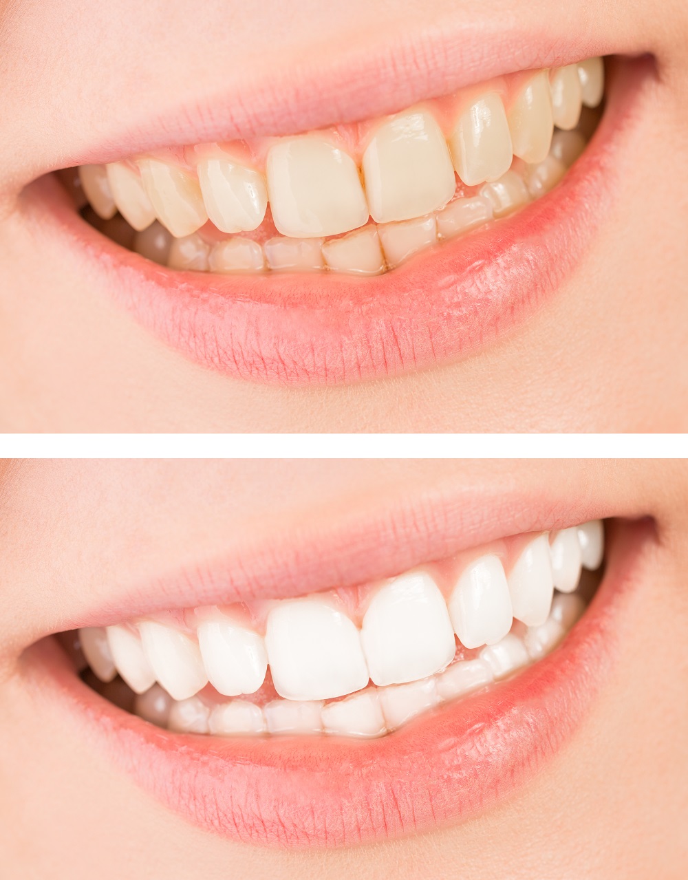 Teeth Whitening Treatment Karve Nagar