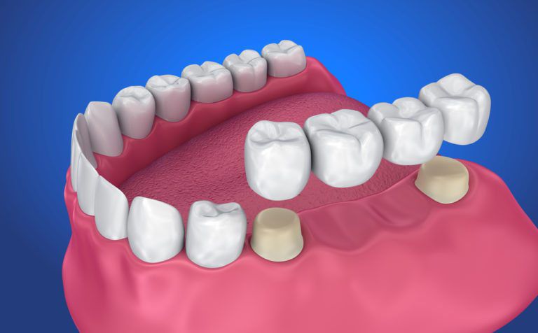 Dental-crown-and-Bridge-768x476.jpg.optimal Best Dental Implant Treatment In Siliguri